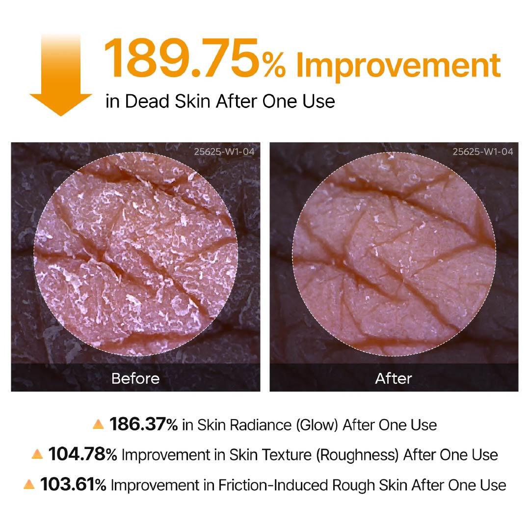 Kojic Acid &amp; Turmeric KP Bump Eraser Body Peeling Spray – Exfoliating Treatment for Smooth, Even Skin